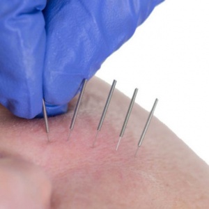 Needle Shaping-Lifting μη χειρουργικό